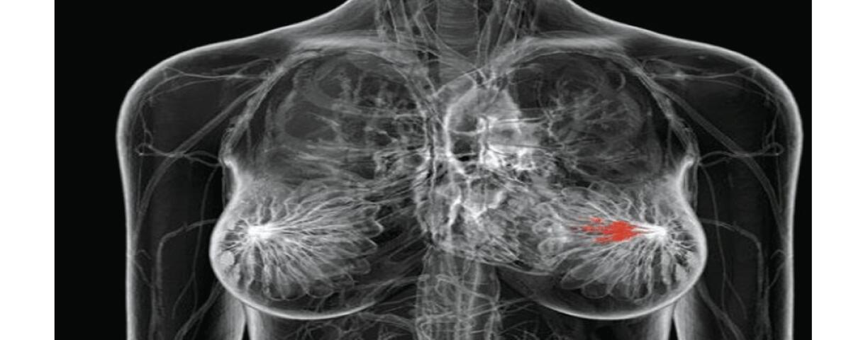 Carcinoma mammario: campagna di prevenzione di Confesercenti - 